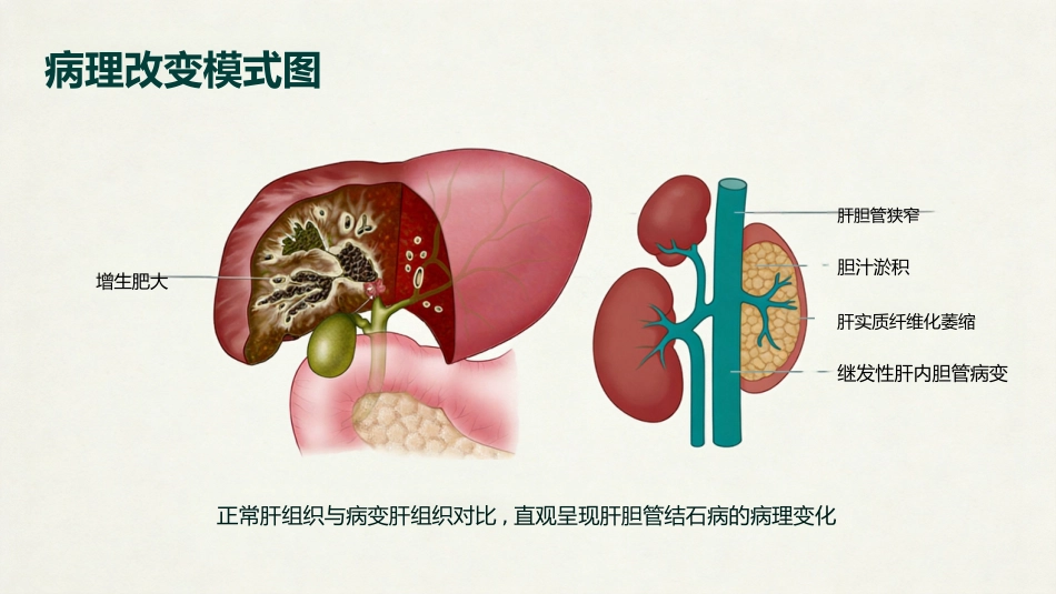 肝内胆管结石_第5页
