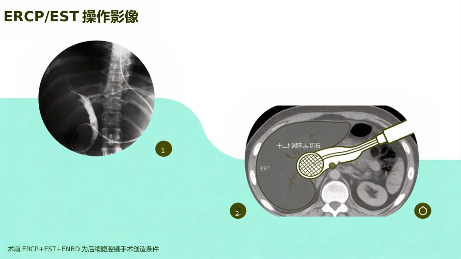 肝胆管结石的三镜联合治疗_第7页