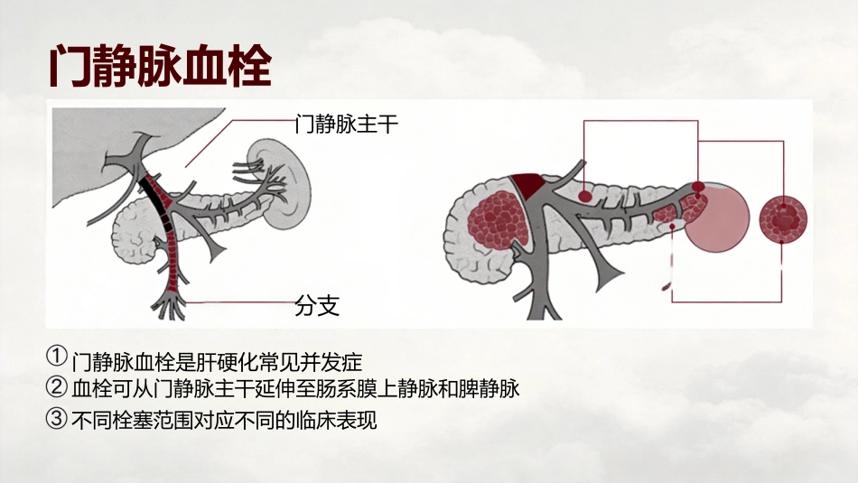 肝病患者的凝血改变_第4页