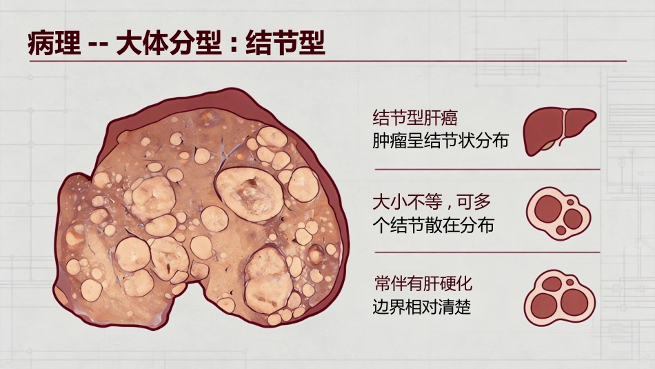 肝癌原发性肝癌_第6页