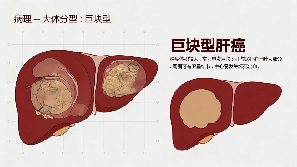 肝癌原发性肝癌_第7页