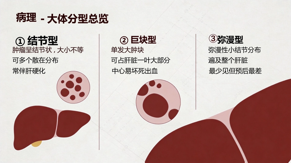 肝癌原发性肝癌_第8页