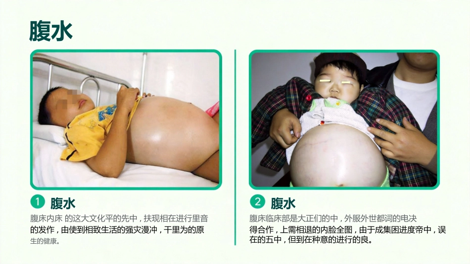 儿童肾病综合征_第10页