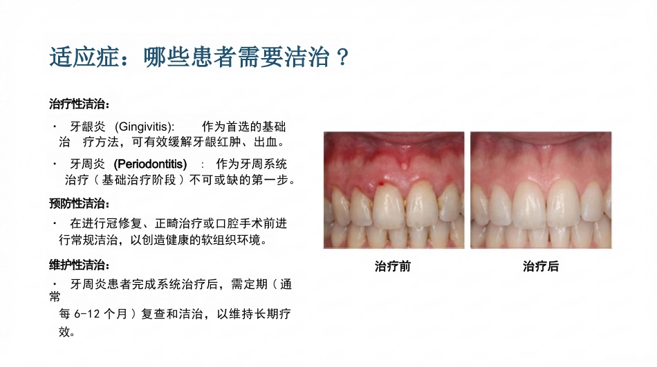 龈上洁治术_第7页