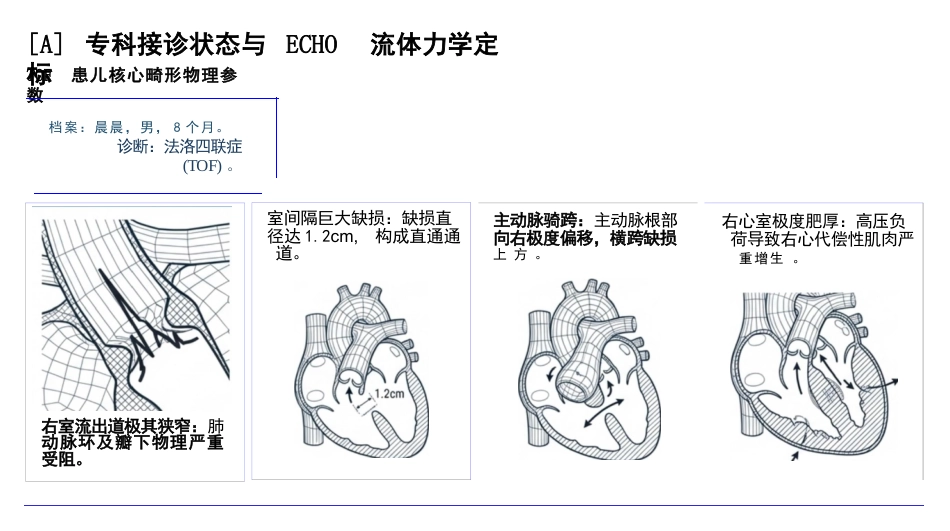 小儿先天性心脏病护理查房_第3页