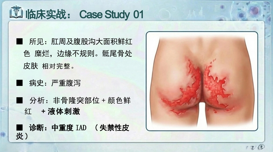 失禁性皮炎预防与护理_第11页
