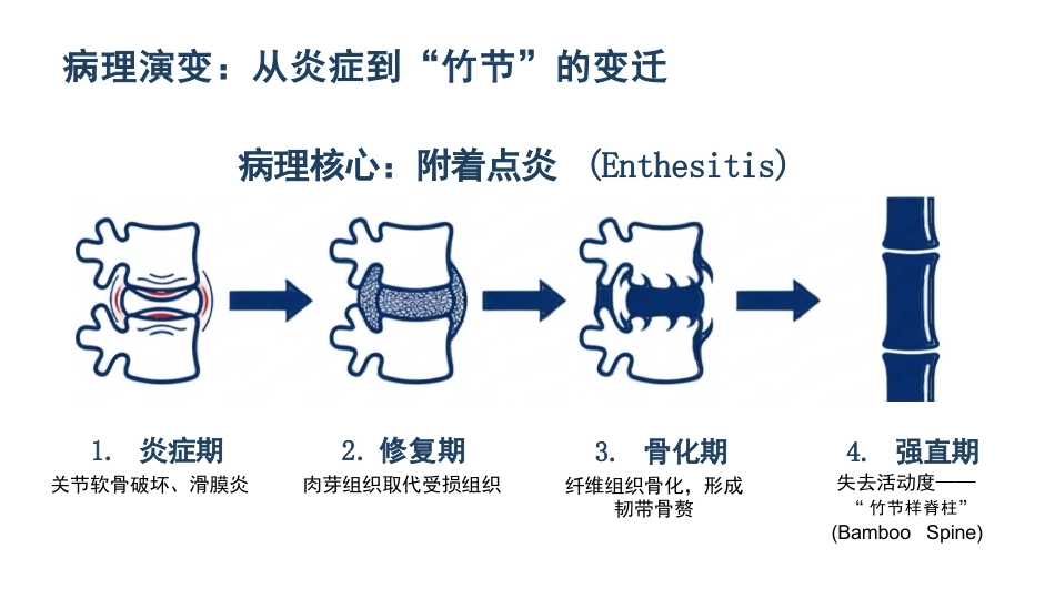 强直性脊柱炎护理查房_第4页