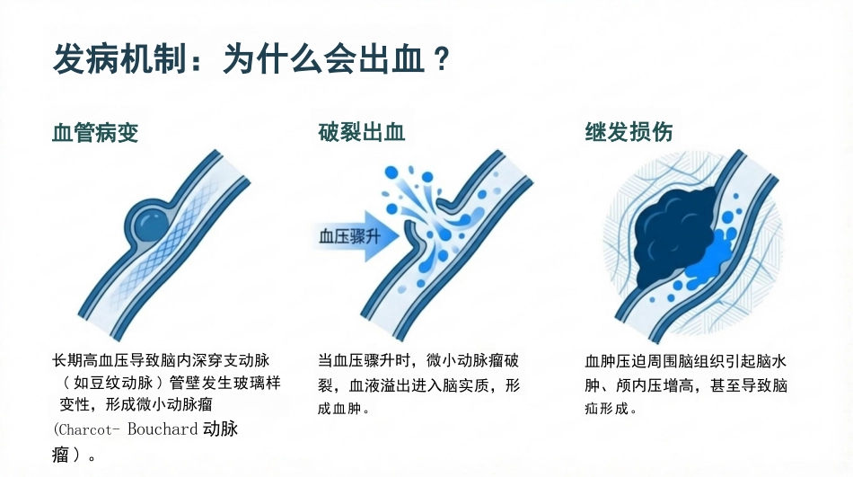 脑出血病人的护理查房_第5页