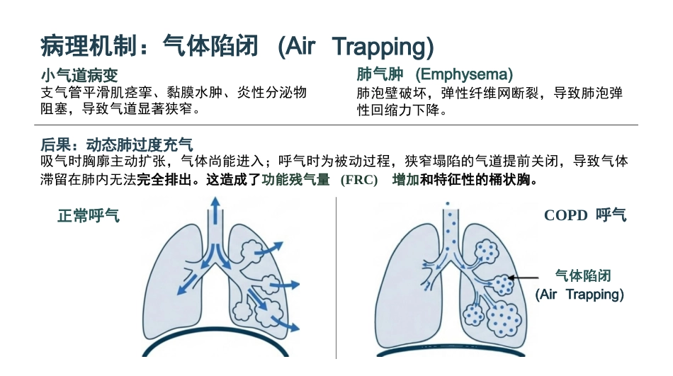 慢阻肺急性加重期护理查房_第4页