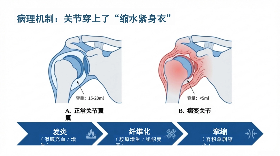 肩周炎康复护理查房_第4页