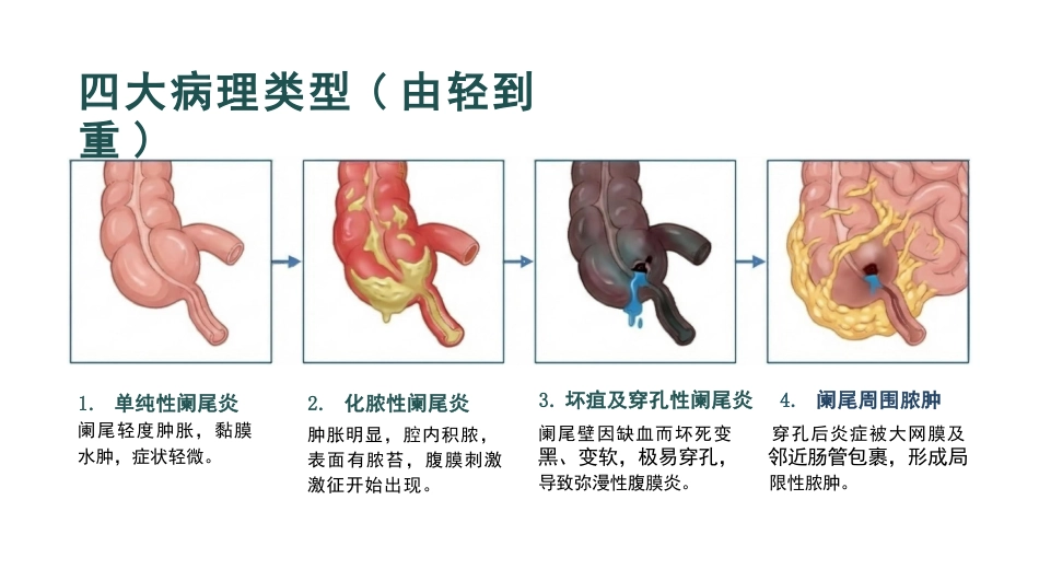 急性阑尾炎病人的护理_第7页