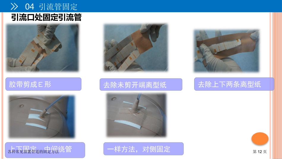 各种常见留置管道的固定方法_第12页