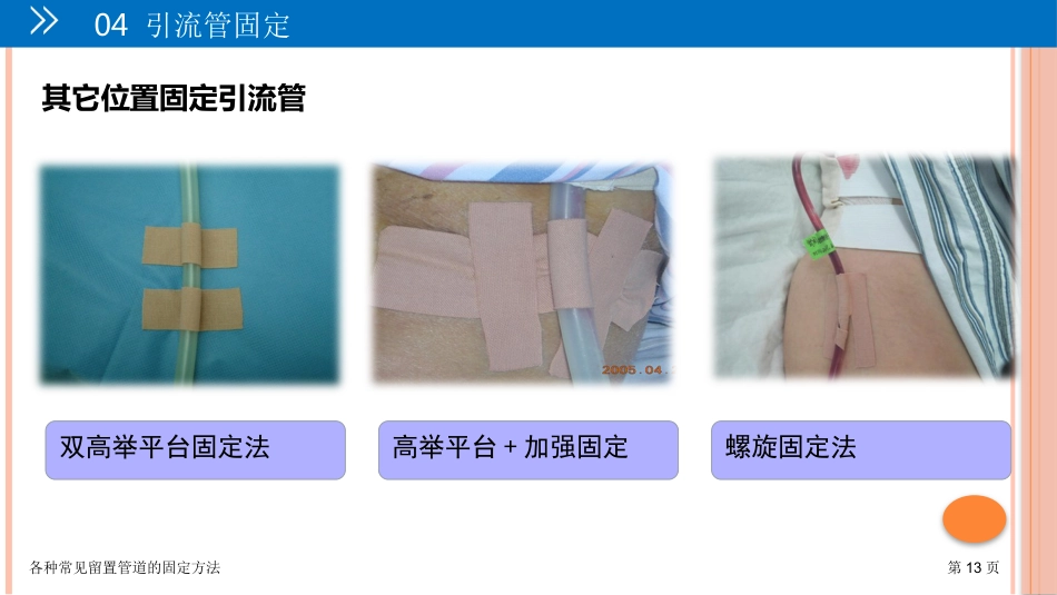 各种常见留置管道的固定方法_第13页