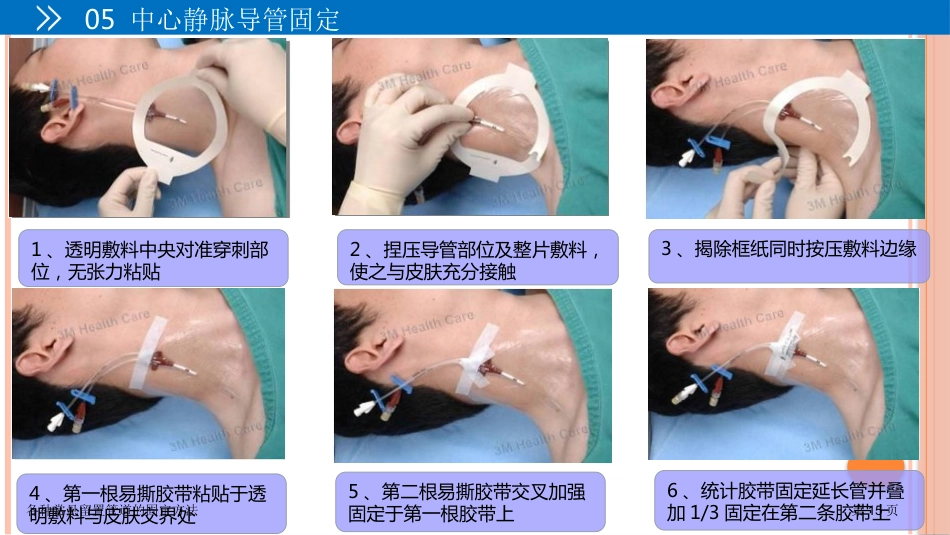 各种常见留置管道的固定方法_第15页