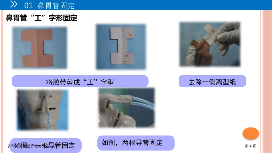 各种常见留置管道的固定方法_第4页