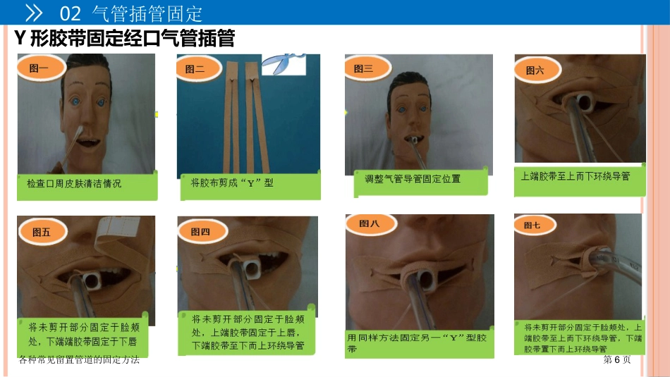 各种常见留置管道的固定方法_第6页