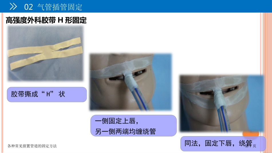 各种常见留置管道的固定方法_第7页