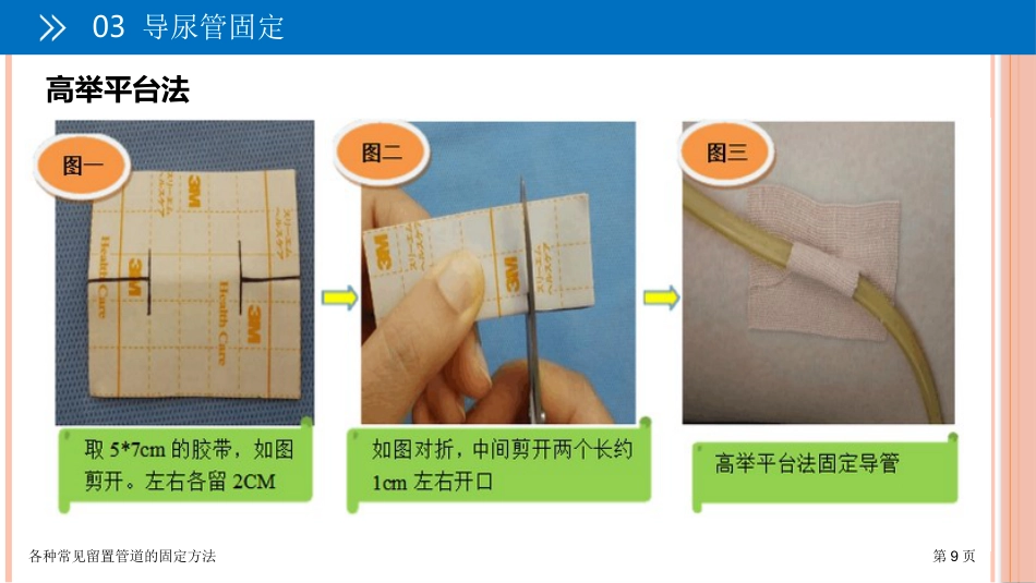 各种常见留置管道的固定方法_第9页