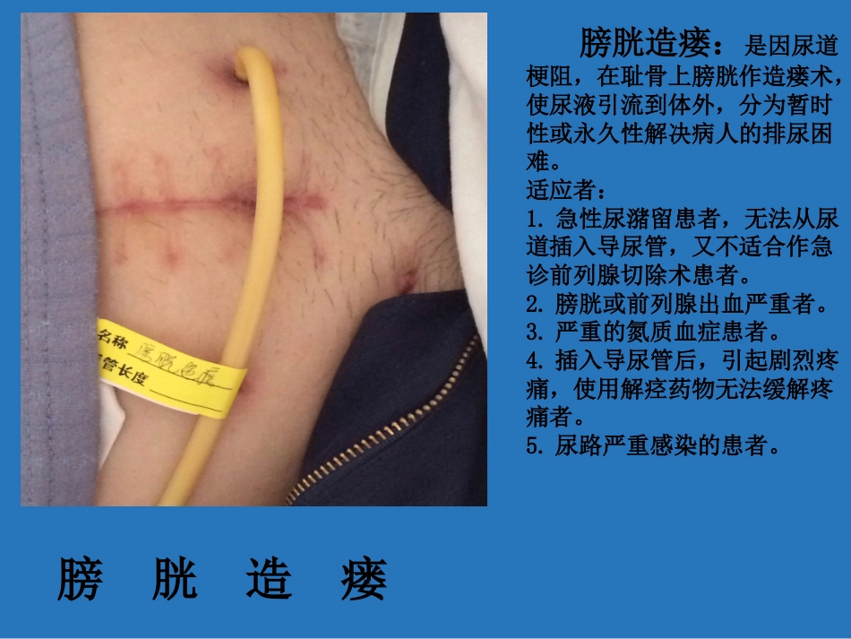 留置管道管理_第11页