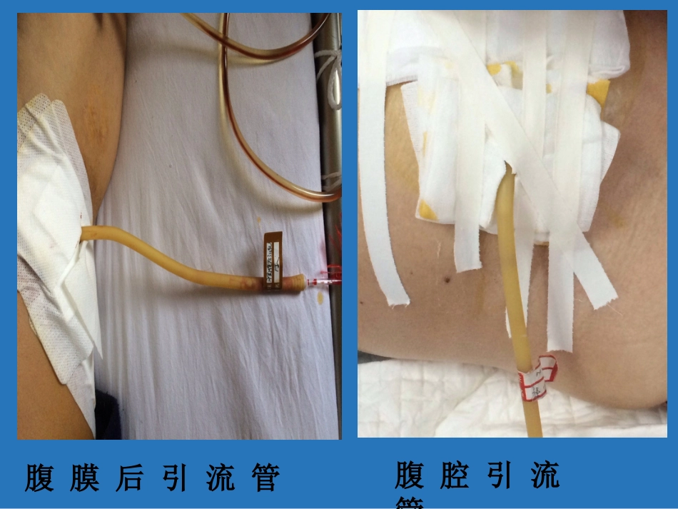 留置管道管理_第12页