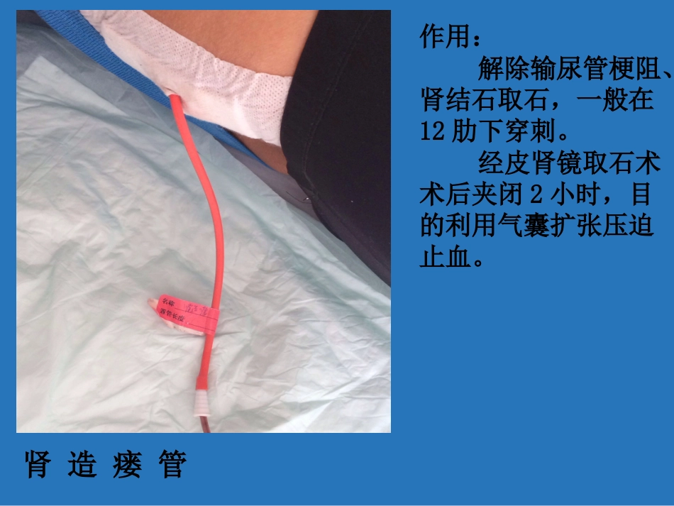 留置管道管理_第15页