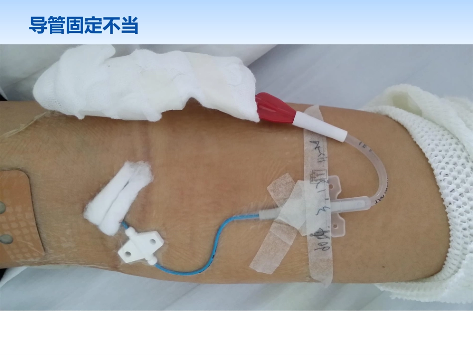picc导管规范化维护_第5页