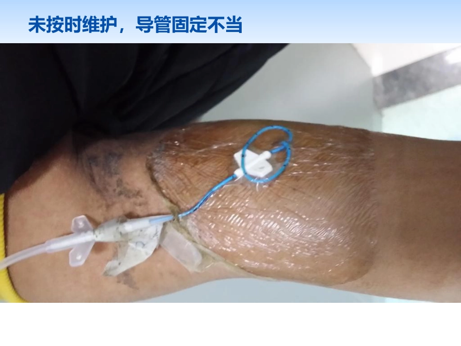 picc导管规范化维护_第6页