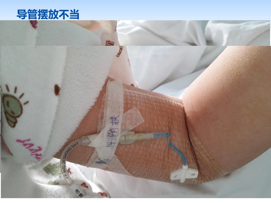 picc导管规范化维护_第7页