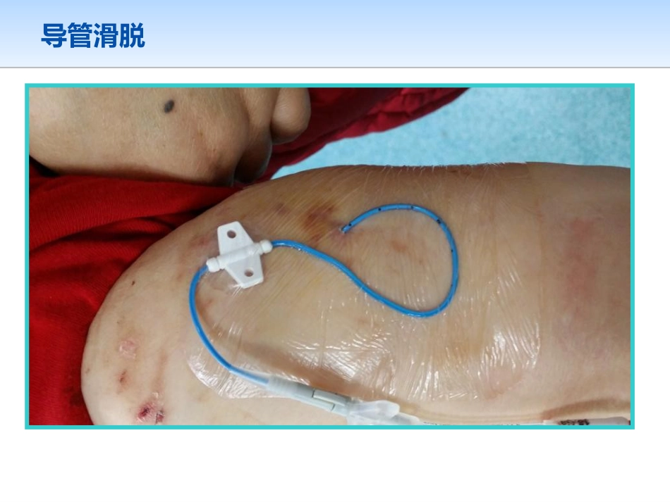 picc导管规范化维护_第9页