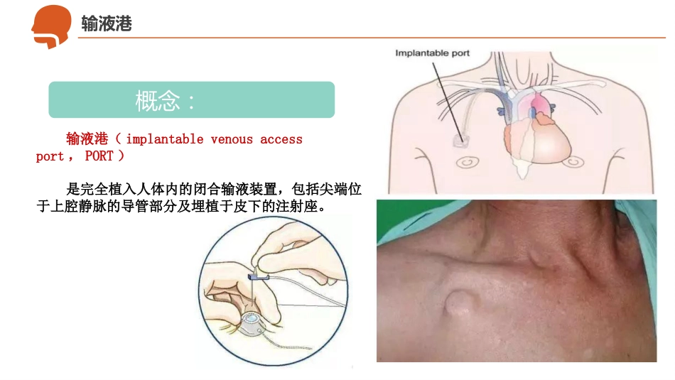 CVC、PICC、输液港--导管护理_第4页