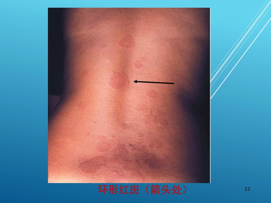 儿科护理学结缔组织疾病PPT课件_第12页