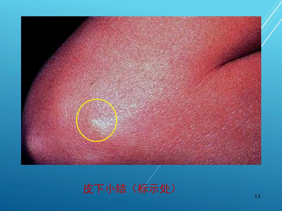 儿科护理学结缔组织疾病PPT课件_第13页