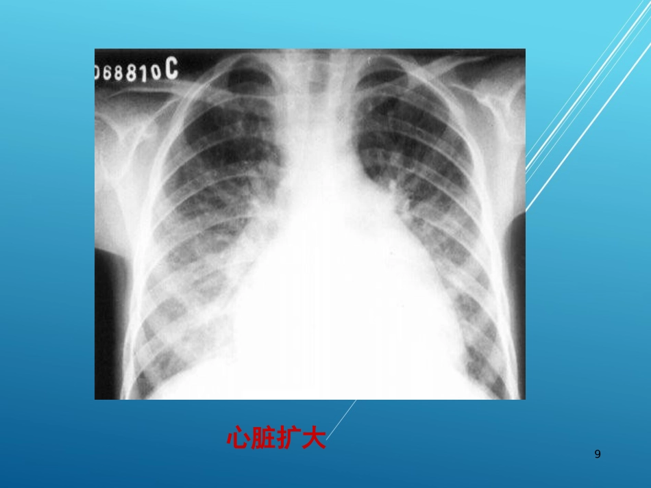 儿科护理学结缔组织疾病PPT课件_第9页