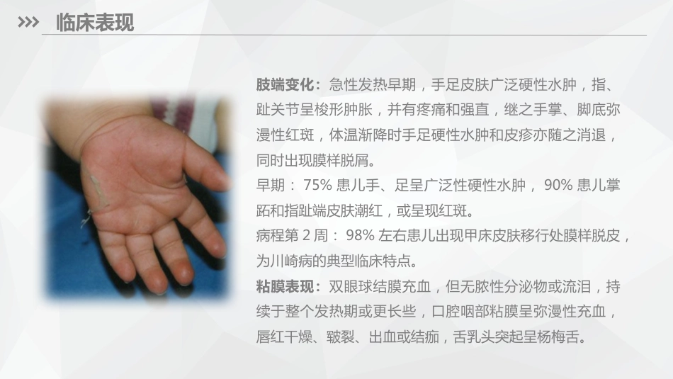 儿科护理：川崎病儿科护理_第11页