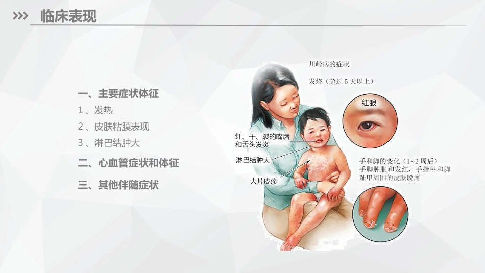儿科护理：川崎病儿科护理_第8页