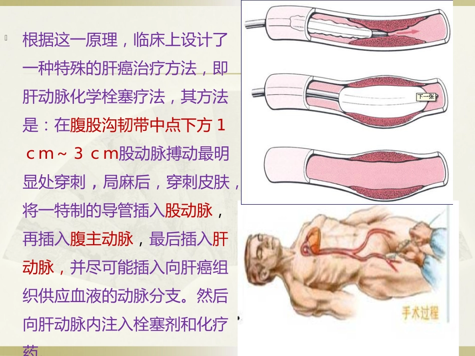 肝癌的介入治疗及护理_第9页