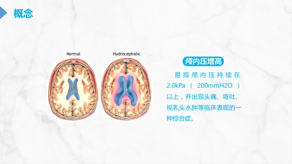 重症护理：颅内压增高的护理PPT_第5页