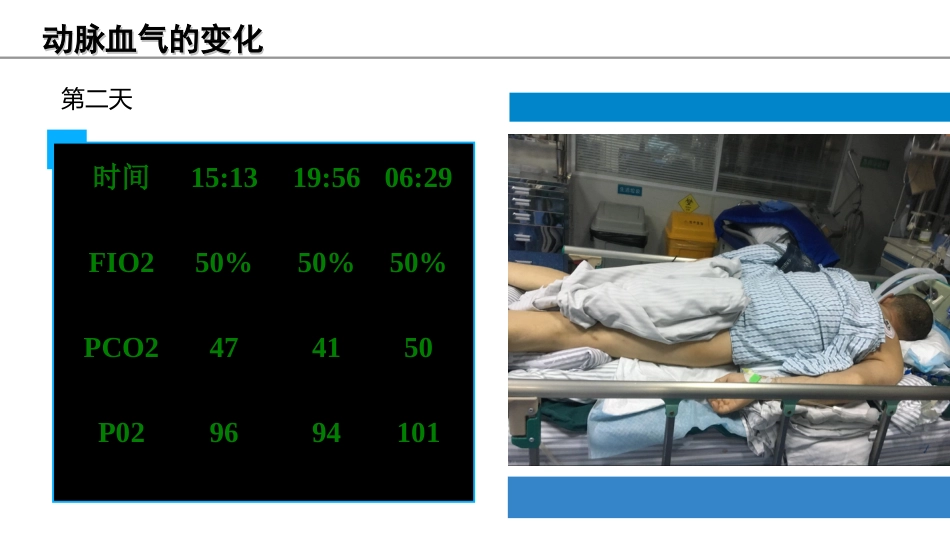 俯卧位通气的护理课件_第13页