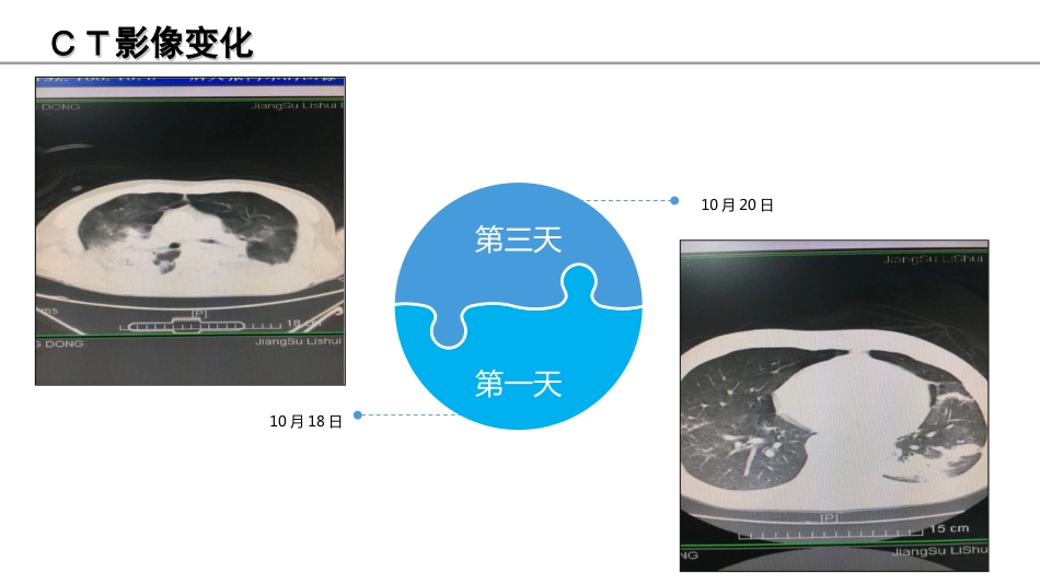 俯卧位通气的护理课件_第14页