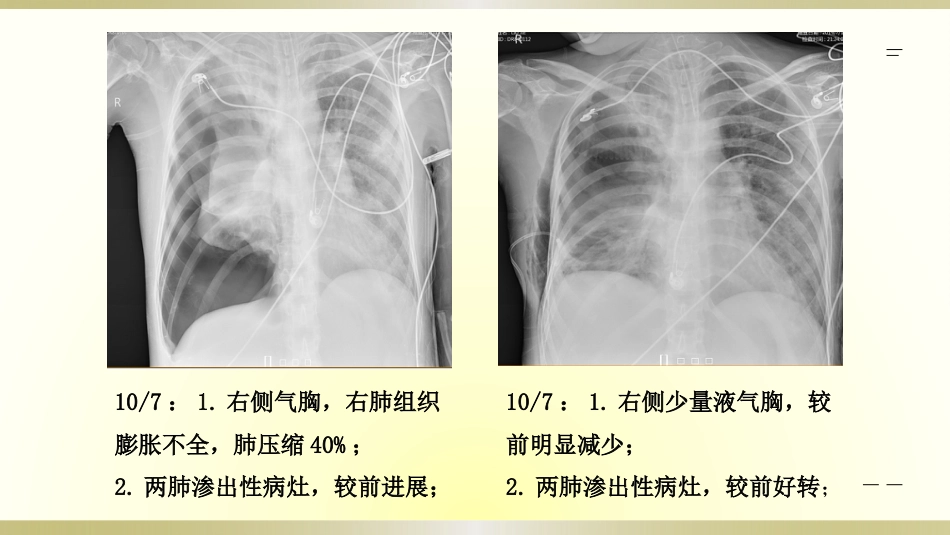 一例脓毒血症患者的护理查房全文_第11页