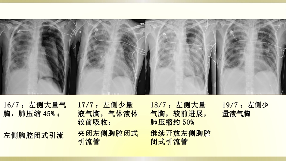 一例脓毒血症患者的护理查房全文_第12页