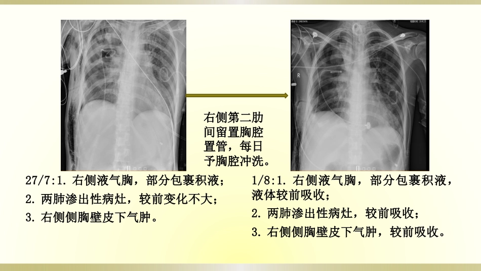 一例脓毒血症患者的护理查房全文_第13页