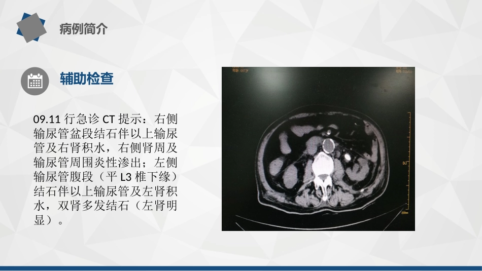 1例孤立肾---输尿结石导致尿源性脓毒血症的护理查房_第6页