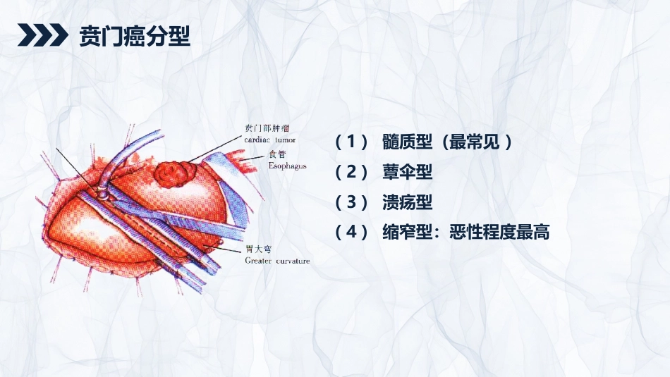 重症护理：贲门癌伴脓胸吻合口瘘护理查房_第6页