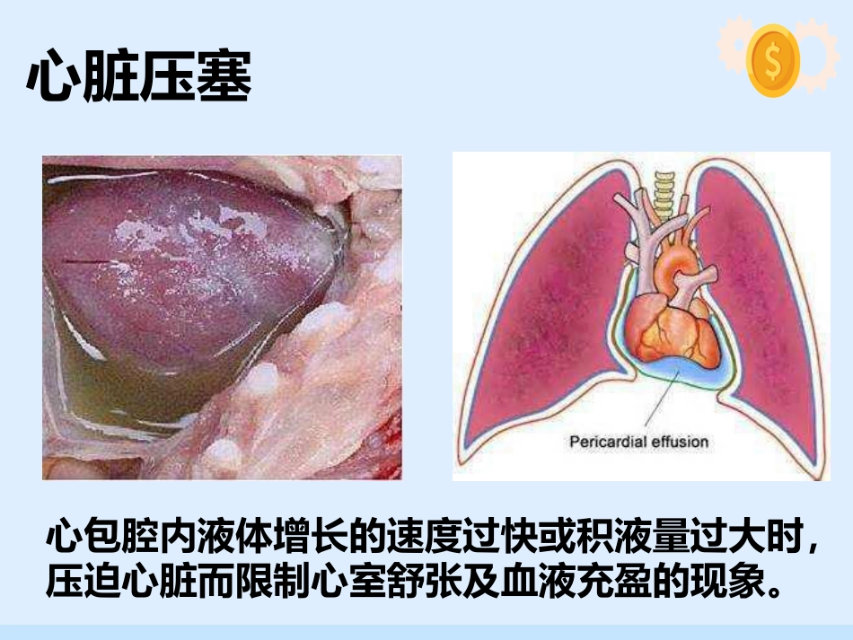 心脏压塞、肺栓塞、血管迷走反射的紧急处理与护理配合_第4页