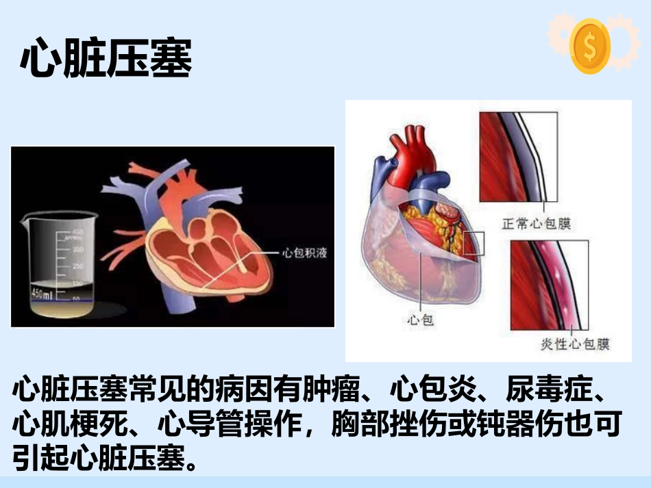 心脏压塞、肺栓塞、血管迷走反射的紧急处理与护理配合_第5页