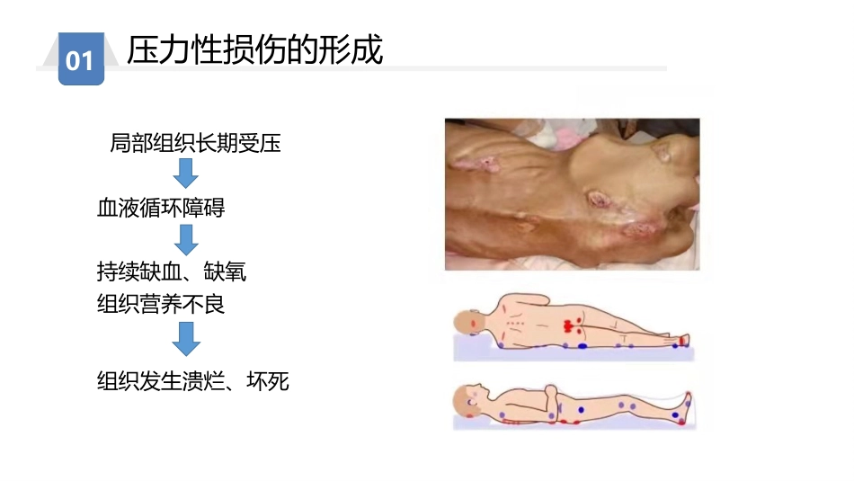 压力性损伤预防及护理_第8页