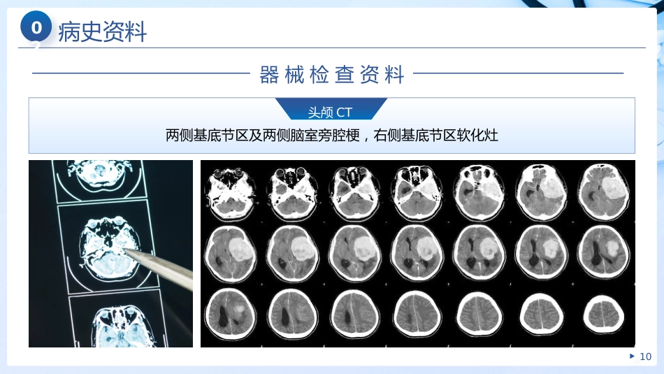 个案护理之脑梗死__第10页