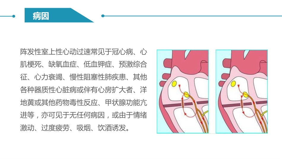 阵发性室上性心动过速护理查房_第5页