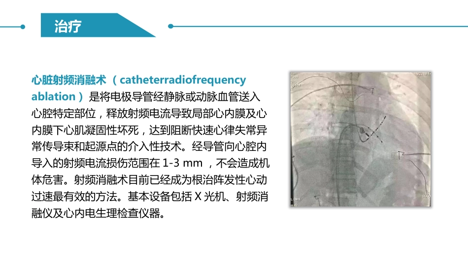阵发性室上性心动过速护理查房_第8页